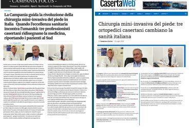5 focus caserta web dott fabrizio sergio ortopedico napoli caserta formia alluce valgo miniinvasivo percutaneo metatarsalgia fascite plantare dito a martello morton haglund