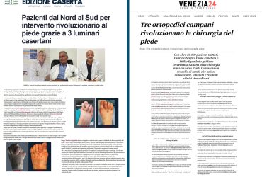 7 venezia24 dott fabrizio sergio alluce valgo più interventi in italia 25000 interventi alluce valgo miniinvasivo metatarsalgia fascite plantare spina dito a martello