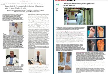 8 caserta news dott fabrizio sergio alluce valgo più interventi in italia 25000 interventi alluce valgo miniinvasivo metatarsalgia fascite plantare spina dito a martello